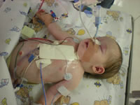 Leah Marx Trust Fund, The first time I saw her I was overwhelmed with love for her. Perfect in every way, ten toes en ten fingers, or so we thought... After holding her for 20min she was taken away to NNICU, she was not getting enough oxygen and turned a little blue. Leah was kept in NNICU (Neo Natal Intensive Care Unit) for about 10 days on oxygen and tube feeding. She was sent home but was back in hospital after a week. She wasn't eating well and therefore not picking up any weight. Another week in hospital and we were back home, Any donations welcome, Donate, Help a child, Pretoria, Gauteng