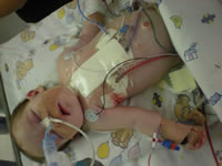 Leah Marx Trust Fund, The first time I saw her I was overwhelmed with love for her. Perfect in every way, ten toes en ten fingers, or so we thought... After holding her for 20min she was taken away to NNICU, she was not getting enough oxygen and turned a little blue. Leah was kept in NNICU (Neo Natal Intensive Care Unit) for about 10 days on oxygen and tube feeding. She was sent home but was back in hospital after a week. She wasn't eating well and therefore not picking up any weight. Another week in hospital and we were back home, Any donations welcome, Donate, Help a child, Pretoria, Gauteng