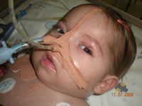 Leah Marx Trust Fund, The first time I saw her I was overwhelmed with love for her. Perfect in every way, ten toes en ten fingers, or so we thought... After holding her for 20min she was taken away to NNICU, she was not getting enough oxygen and turned a little blue. Leah was kept in NNICU (Neo Natal Intensive Care Unit) for about 10 days on oxygen and tube feeding. She was sent home but was back in hospital after a week. She wasn't eating well and therefore not picking up any weight. Another week in hospital and we were back home, Any donations welcome, Donate, Help a child, Pretoria, Gauteng